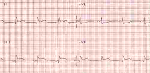 inferior MI on EKG showing ST elevation in leads II, III and aVF